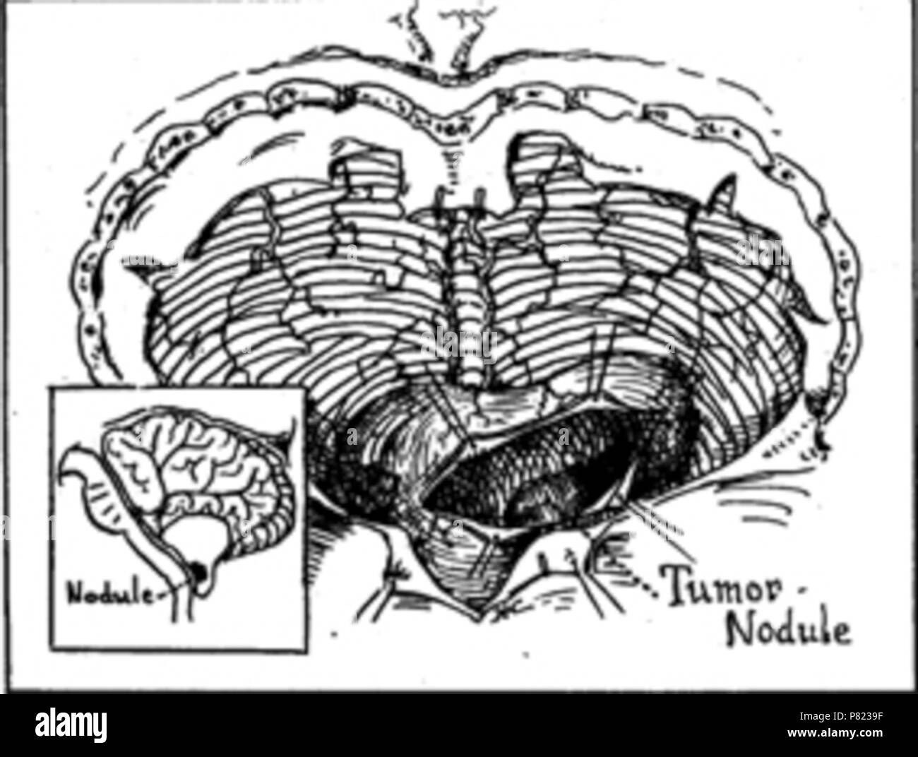 English: Picture from article of founder of world and american neurosurgery Harvey Cushing (died 1939) which shows cerebellum and hemangioblastoma (Cushing`s case report) . 14 April 2012 63 Cerebellar hemangioblastoma Stock Photo